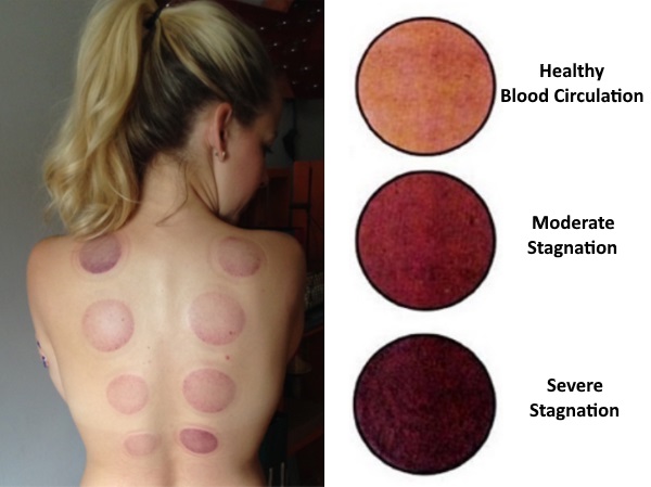 Cupping Marks Cupping Therapy Keyport NJ