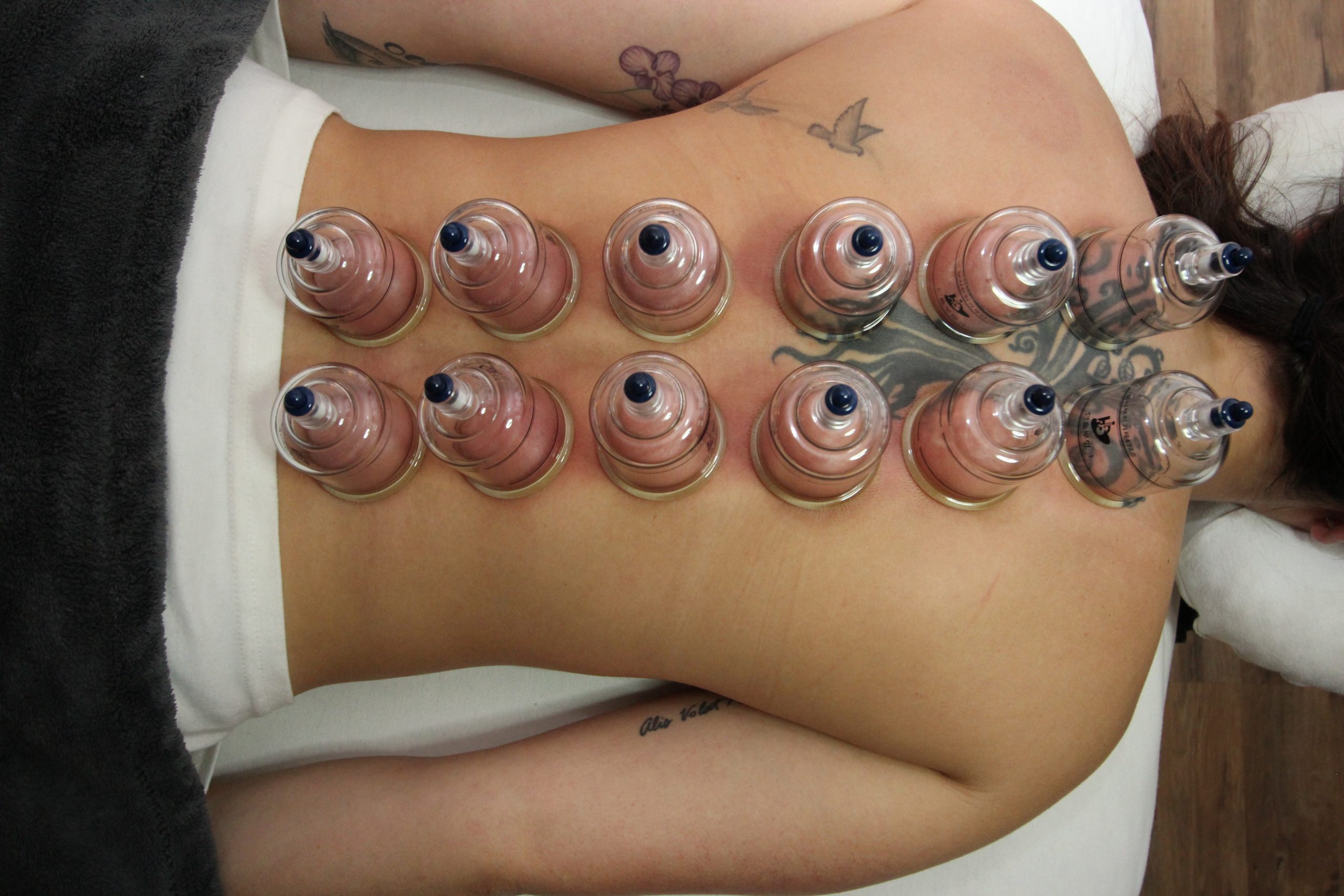 Cupping Therapy Keyport NJ